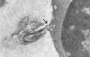 F,1y. | bone marrow … dyserythropoetic anemia v.s.